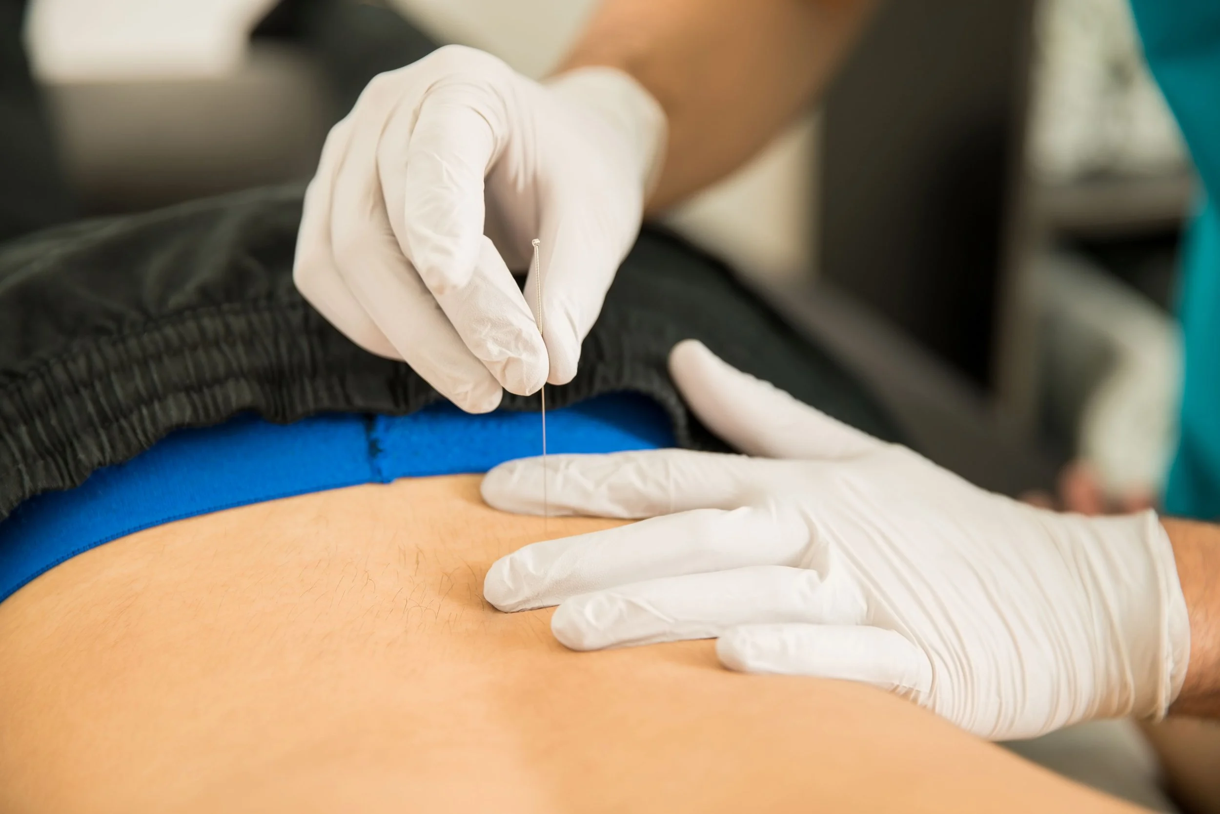 dry+needling+for+low+back+pain